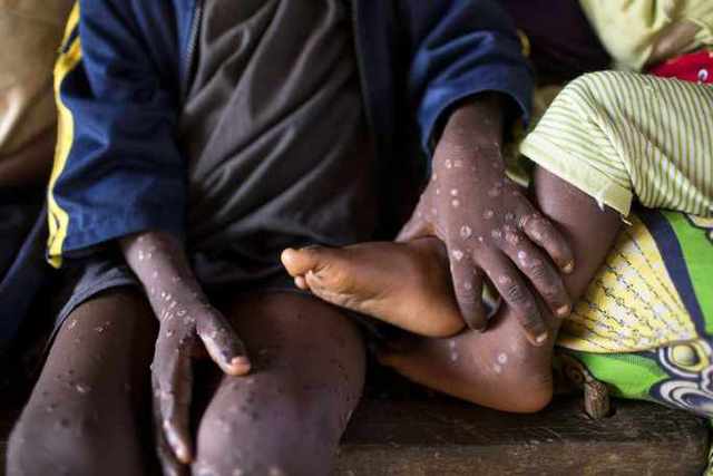 Châu Phi công bố 103 ca ​​tử vong vì bệnh đậu mùa ở khỉ, cảnh báo các đường lây truyền khác - Ảnh 1.